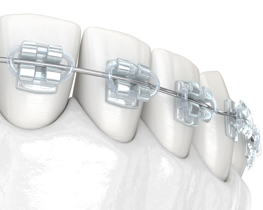 Tooth-coloured ceramic braces that appear translucent on teeth.