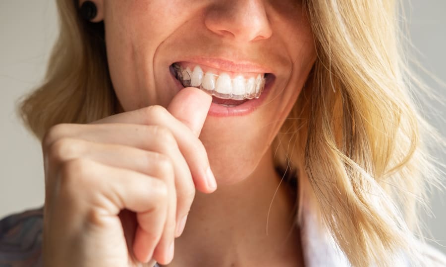 A woman with white teeth slides on a set of Invisalign clear aligners.