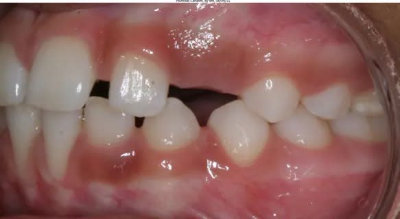 Right side teeth together with cheek retracted with spoon